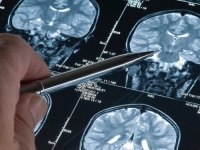 SENZACIONALNO OTKRIĆE: Prvi lijek koji usporava razaranje mozga Alzheimerovom bolešću označen je kao...