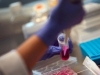 NA OVO SE DUGO ČEKALO: Prva žena izliječena od HIV-a nakon transplantacije...