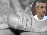 BOLEST STIGLA U EVROPU: Kako se šire majmunske boginje i koji su simptomi?