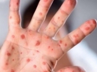 PREDNOST NAJTEŽE POGOĐENIM ZEMLJAMA: EU počinje isporučivati vakcine protiv majmunskih boginja