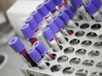 OVE INFORMACIJE SU NEPROCJENJIVE: Šta su analize krvi i zašto su važne za zdravlje?