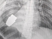 ČUDA SE DEŠAVAJU: Hirurzi iz tijela ukrajinskog vojnika uklonili neeksplodiranu granatu (FOTO)