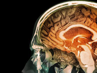 ZNANSTVENICI DOŠLI DO VAŽNE SPOZNAJE: Jedna stvar je ključna u predviđanju razvoja smrtonosnog tumora mozga…