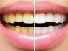 TRIKOVI ZLATA VRIJEDNI: Kako sebi možete pomoći ukoliko vam zubi brzo mijenjaju boju…