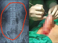 'KAKO JE OVO MOGUĆE': Medicinsko osoblje u nevjerici gledalo šta hirurg izvlači iz želuca pacijenta (FOTO)