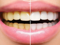 TRIKOVI ZLATA VRIJEDNI: Kako sebi možete pomoći ukoliko vam zubi brzo mijenjaju boju…