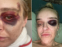 UŽAS U SARAJEVU: Radnik na parkingu brutalno pretukao mladu doktoricu (FOTO)
