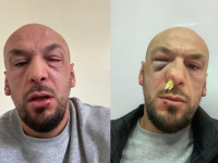 U SARAJEVU NAPADNUT IRON PUKI, DOSTAVIO I NALAZ SA KCUS-a: 'Adnan Redžović me udario, idem da ga prijavim policiji'