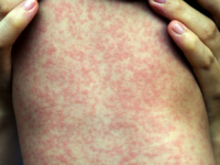 VAKCINALNI PUNKTOVI ZATVORENI: Broj oboljelih od morbila u Kantonu Sarajevo raste, trenutno ih je preko 800