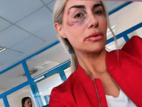 SELMA BAJRAMI ZAPREPASTILA JAVNOST FOTOGRAFIJOM KOJU JE OBJAVILA: Njeno lice je u modricama, podijelila sliku iz...