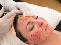 SVE ZBOG PODMLAĐIVANJA: Tri žene zaražene HIV-om tokom vampirskog tretmana