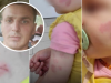 DJEVOJČICA KOD LJEKARA DOVEDENA IZ VRTIĆA S VIŠE UGRIZNIH RANA: Tete tvrde da je pala, otac sve prijavio policiji