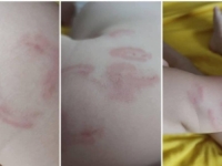 SLUČAJ BEBE KOJU SU 14 PUTA IZGRIZLI U SARAJEVSKOM VRTIĆU: Ministarstvo naložilo novi inspekcijski nadzor