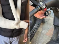 RASISTIČKI NAPADI U SPLITU: Dvojica Nepalcu slomila ruku, Indijca gađali kamenjem i pretukli ga...