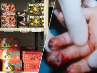 TRAGEDIJA U SUSJEDSTVU: Dječak zbog petarde izgubio vid, zadobio opekotine i višestruke prelome šake