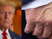 SIMPTOMI SU ALARMANTNI: Donald Trump boluje od kronične bolesti, prvo otiču ruke i noge...