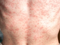 VLASTI U BEČU IZDALE UPOZORENJE: Bilježe porast broja oboljelih od ospica i hepatitisa A