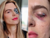 IZNENADNI SINDROM ŽENU DOVEO NA RUB SMRTI: Nakon što je popila ibuprofen, ostala gotovo potpuno slijepa