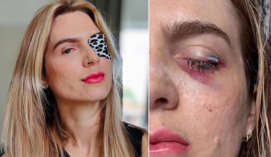 IZNENADNI SINDROM ŽENU DOVEO NA RUB SMRTI: Nakon što je popila ibuprofen, ostala gotovo potpuno slijepa