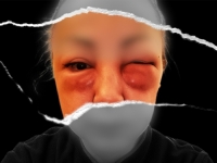 ŠOKANTNA PRIČA CIN-a UPOZORENJE SVIM DJEVOJKAMA I ŽENAMA: Opasni estetski zahvati u sumnjivim 'ordinacijama' u BiH