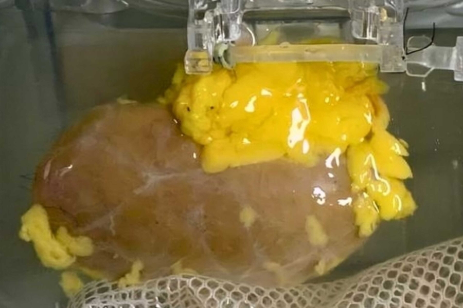 NEVJEROVATNAN USPJEH MODERNE MEDICINE: Naučnici stvorili 'univerzalni' bubreg koji odgovara bilo kojoj krvnoj grupi