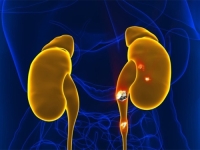 SJAJNE VIJESTI ZA BUBREŽNE BOLESNIKE: Uskoro bi česti i bolni zahvati razbijanja kamenca mogli postati prošlost...