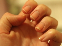 OBRATITE PAŽNJU: Promjene na noktima mogu ukazivati na ozbiljne zdravstvene probleme