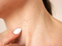 STRAH OD KOŽNIH IZRASLINA: Kada su bezazlene, a kada alarm za posjetu ljekaru