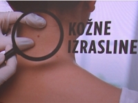 OBRATITE PAŽNJU: Ukoliko imate ovakve izrasline na koži – odmah se obratite ljekaru...