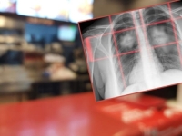 PAZITE ŠTA JEDETE: Ova hrana povećava rizik od raka pluća