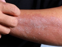 STRUČNJACI UPOZORAVAJU: Ukoliko imate ove simptome – odmah se javite doktoru, postoji opasnost od kožnih bolesti...