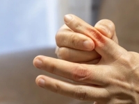 NEUGODNA I PODMUKLA BOL: Uzroci ove bolesti često se prepisuju stilu života i prehrani, ali nije sve baš tako...