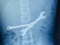 MUŠKARAC ZAVRŠIO U BOLNICI ZBOG BOLOVA U STOMAKU, DOKTORI ZANIJEMILI KADA SU OTKRILI UZROK: 'Ne znamo kako je živ'