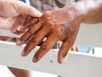 VRATILA SE OPASNA BOLEST: U susjedstvu potvrđen slučaj gube kod stranog radnika