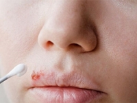 ALARMANTNO: Obratite pažnju na simptome herpesa, ovako ga možete prevenirati...