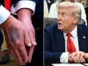 TRUMP KONAČNO RIJEŠIO 'MISTERIJU': Objasnio zašto ima MODRICE po rukama