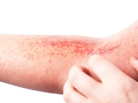 OBRATITE PAŽNJU: Ove promjene na koži mogu ukazivati na problem s jetrom