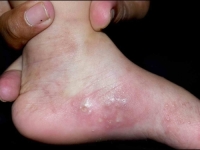 OVA BOLEST SE LAKO ŠIRI: Potvrđena šuga u susjedstvu