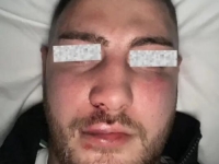 INCIDENT NA NACIONALNOJ OSNOVI: Mladić i djevojka iz Zagreba brutalno pretučeni u Beogradu