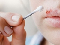 NIJE BEZAZLENO: Ukoliko često imate problema sa herpesom – ovo trebate znati...