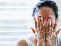 BOLEST KOJA UOPŠTE NIJE BEZAZLENA: Pacijenti često stigmatizirani zbog čega se nalaze u nevolji