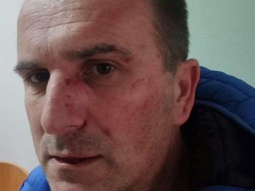 ZAVRŠIO U BOLNICI: Aktivista SDS-a brutalno pretučen jer je otkrio ovu aferu (FOTO)