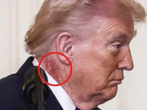 PANIKA U BIJELOJ KUĆI: Šta je to na Trumpovom vratu?