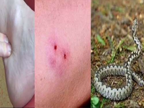 RAZBIJANJE MITOVA: Šta učiniti ukoliko vas ugrize zmija otrovnica ili stršljen...