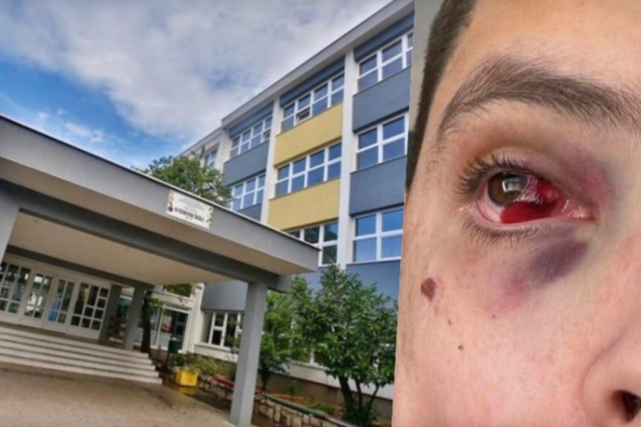 SKANDAL TRESE HERCEGOVINU: Učenik završio u bolnici nakon vršnjačkog nasilja, direktorica pobjegla iz države dok institucije šute