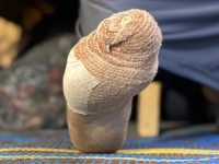 TRAUME PALESTINACA: 'Štakori su mi izgrizli nožne prste' - Doktori u Gazi šokirani ranama koje vide