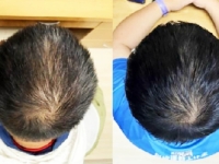 TAJNI RECEPT ZA GUSTU KOSU: Tim stručnjaka izumio serum koji rješava problem ćelavosti bez agresivne hemije i skalpela