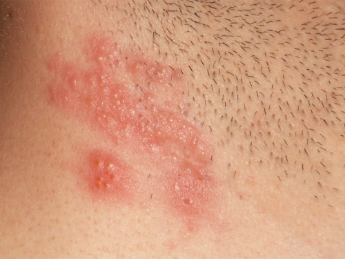 OBRATITE PAŽNJU: Simptomi bolesti slični su vodenim kozicama, a onda nastaje pakao...