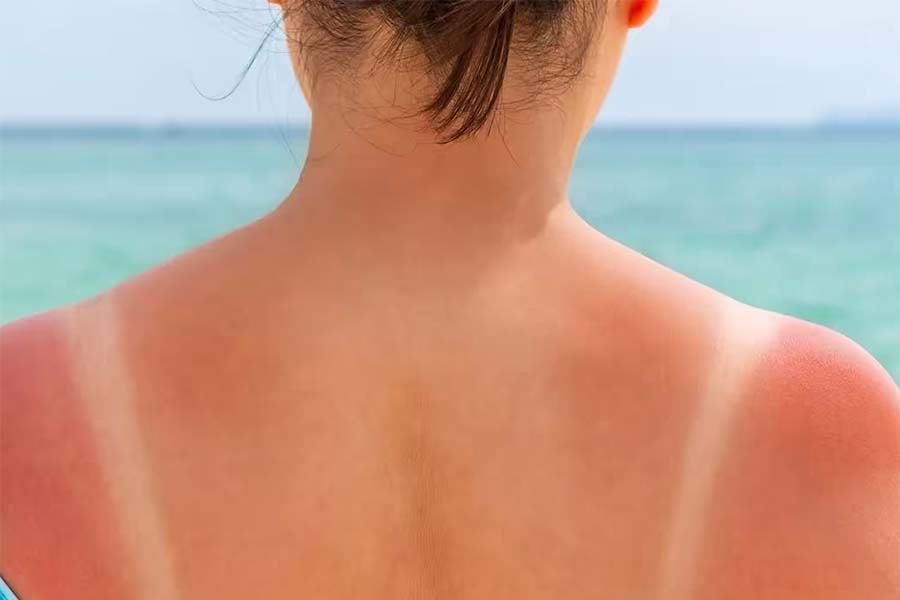 OPREZ NA PLAŽAMA: Cijena sunčanja bez zaštite — od opekotina do onkologije...