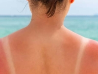 OPREZ NA PLAŽAMA: Cijena sunčanja bez zaštite — od opekotina do onkologije...